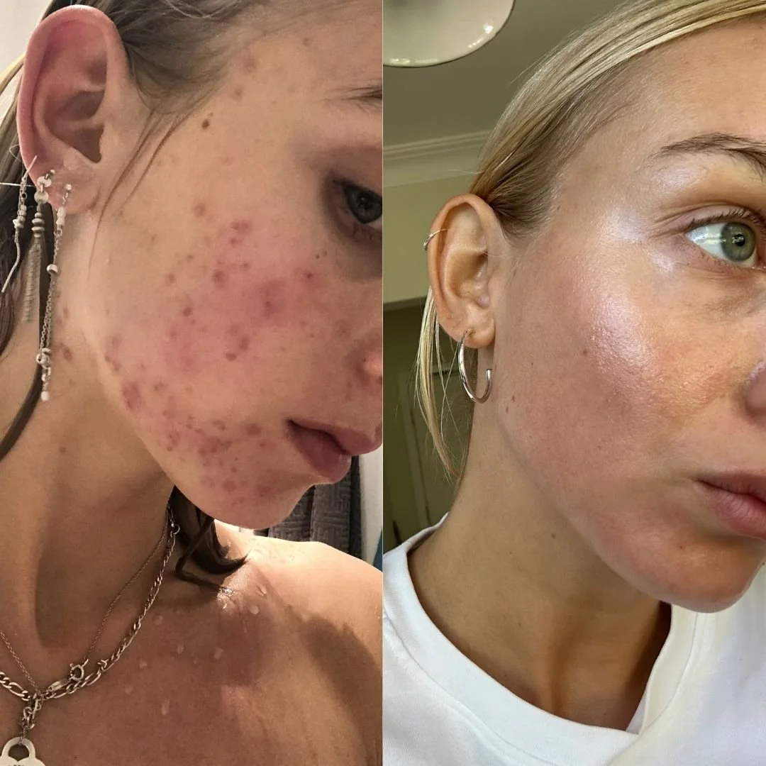 Side-by-side comparison of a woman's face, showing significant reduction in acne and skin redness in the after photo, with clear, smooth skin.