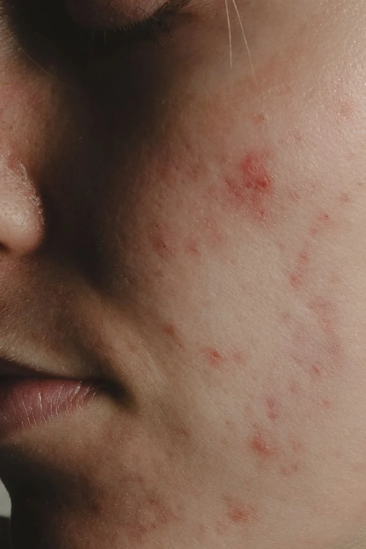 Close-up of a person's cheek showing acne and pimples.