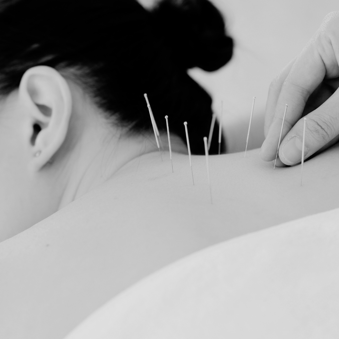 Acupuncture and dry needling treatment at Grey Lynn Physio, Grey Lynn Auckland