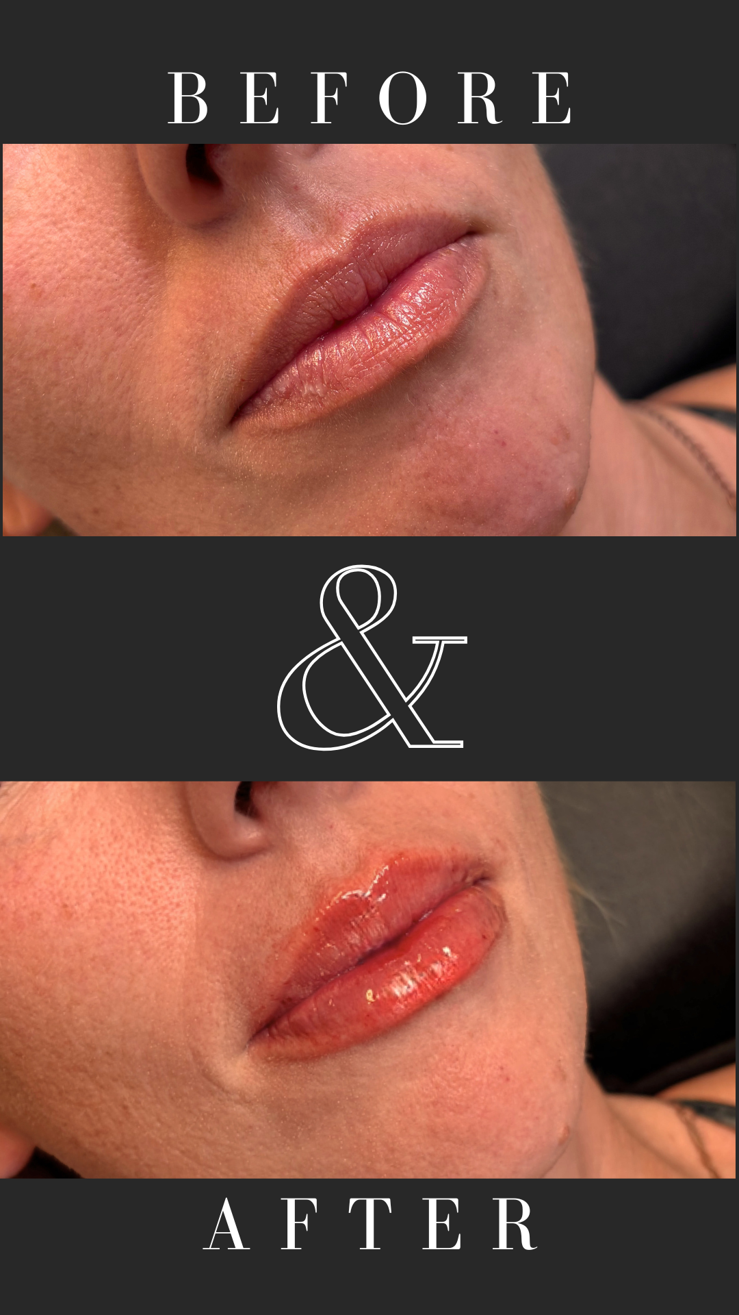 lip fillers 0.5 ml (Revolax)