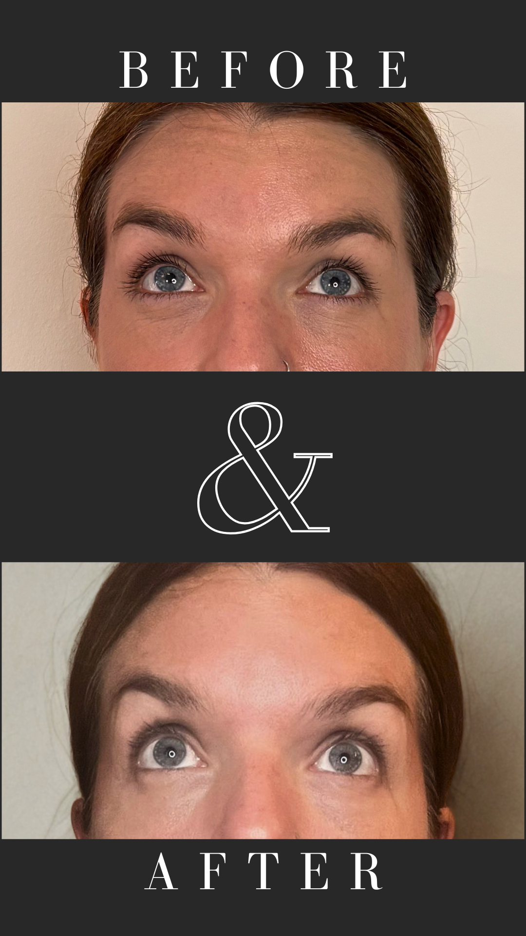 Anti-wrinkle treatment of forehead: top-up
