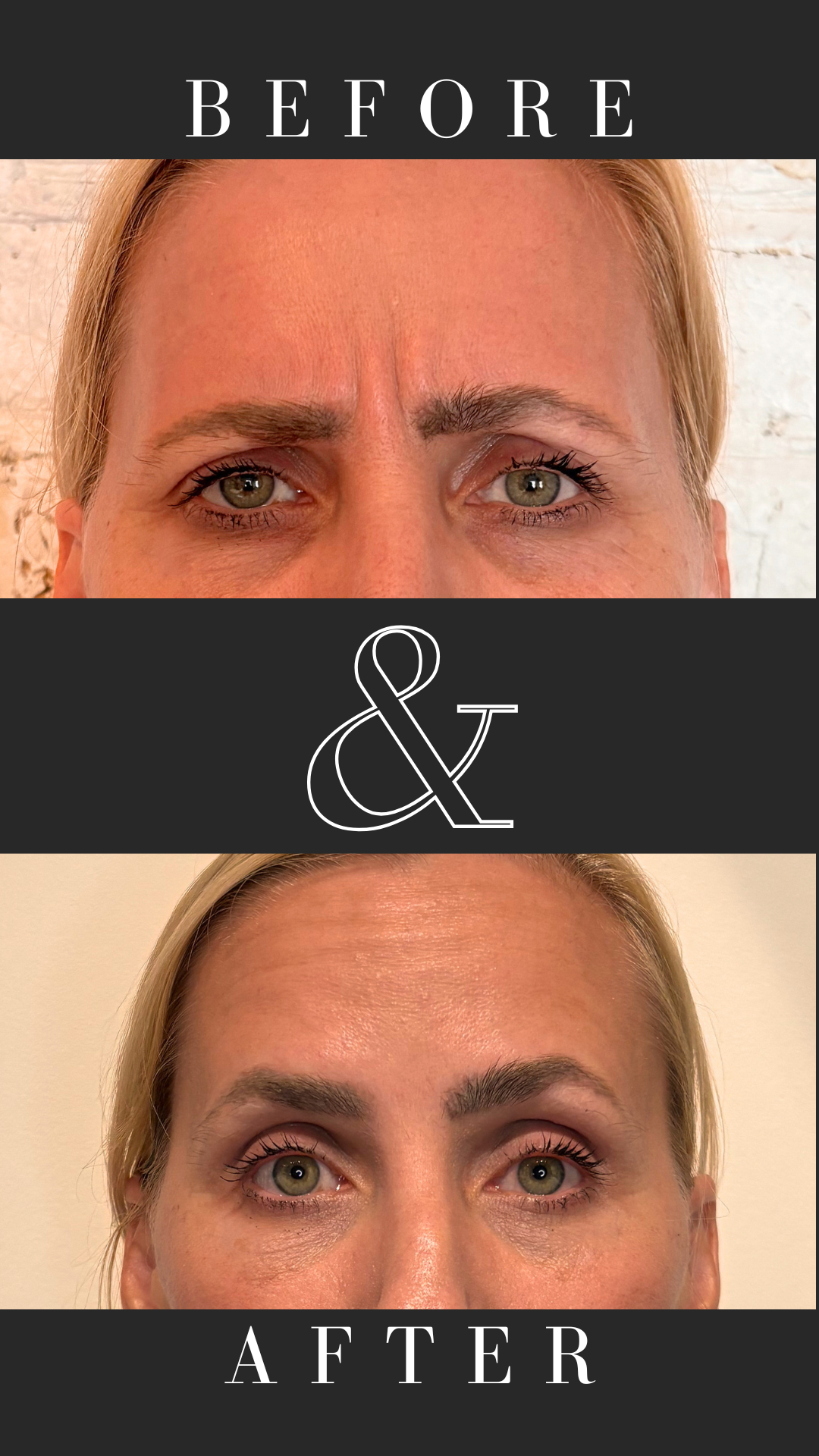 Anti wrinkle treatment- frown lines