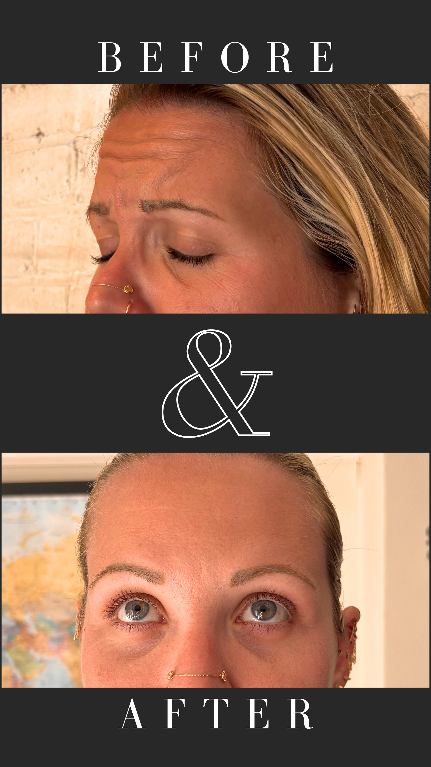 Anti-wrinkle treatment of forehead