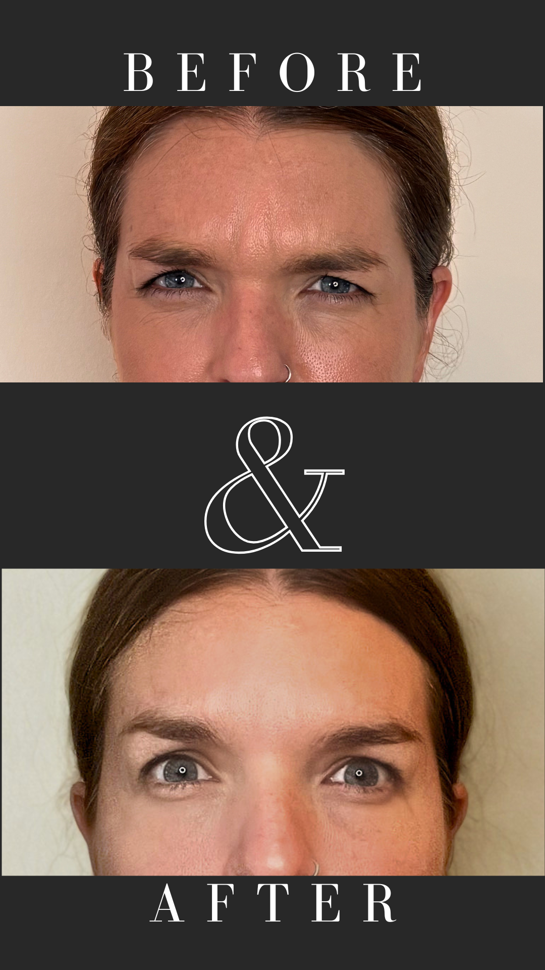 Anti-wrinkle treatment of frown lines: top-up