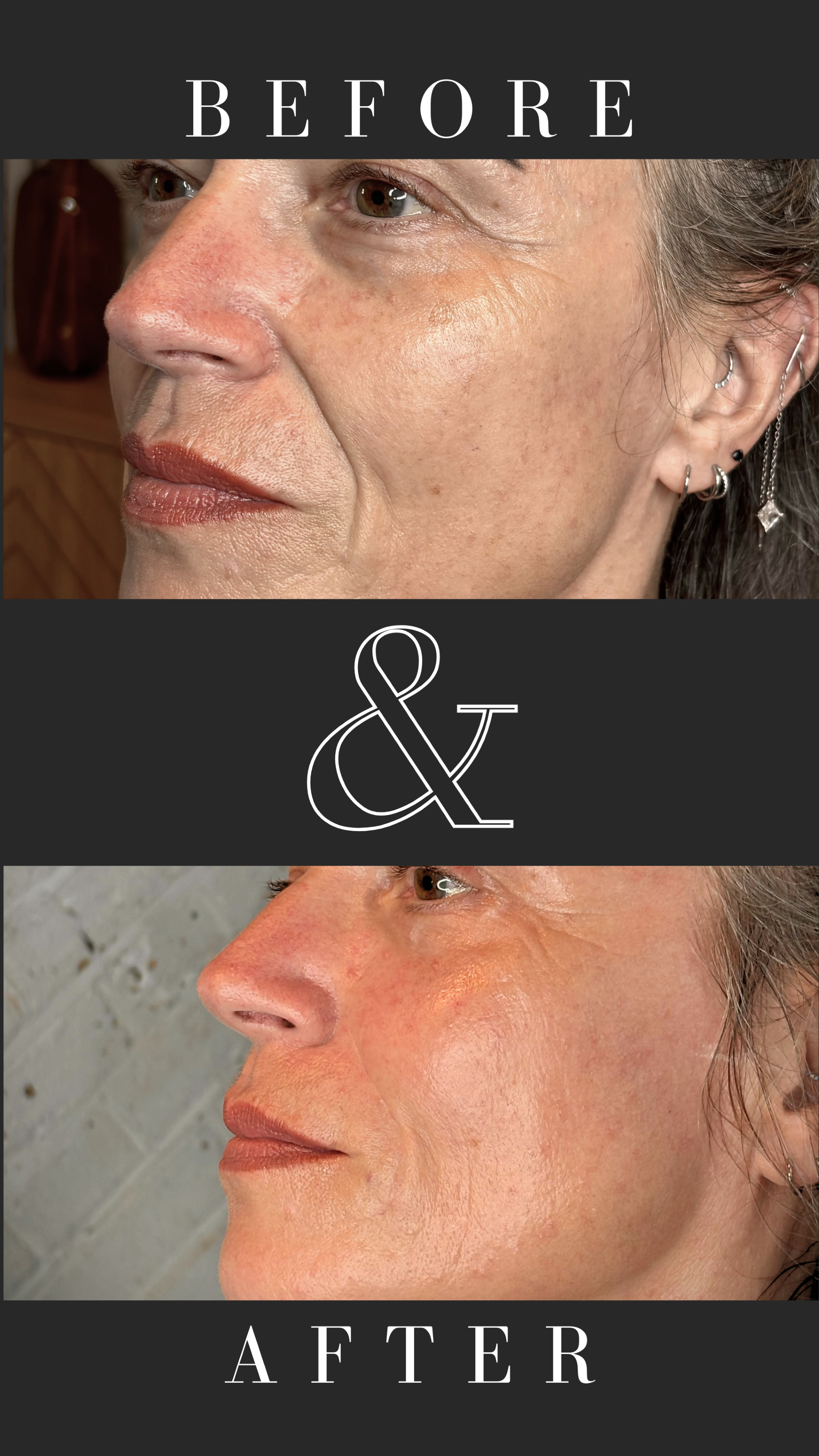 Dermal fillers in cheeks and marionette lines.