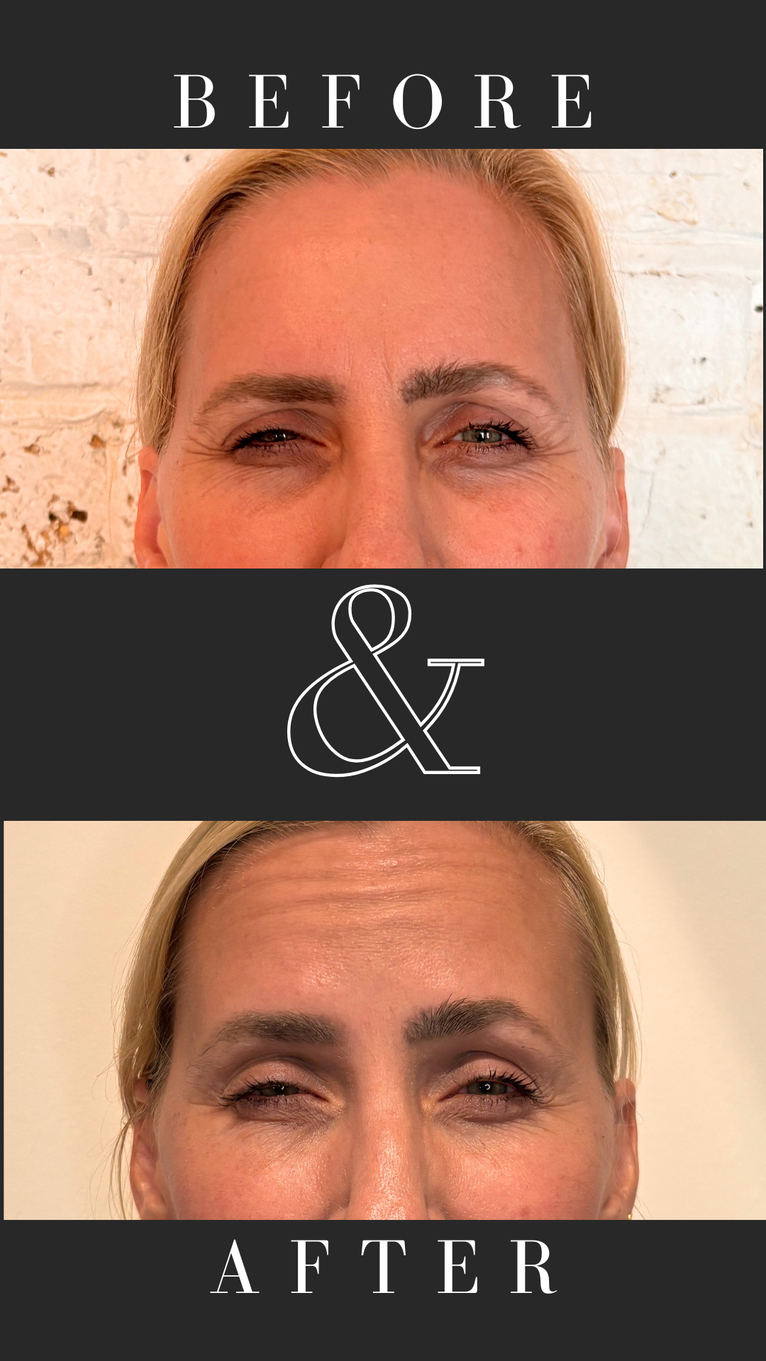 Anti-wrinkle treatment- crows feet
