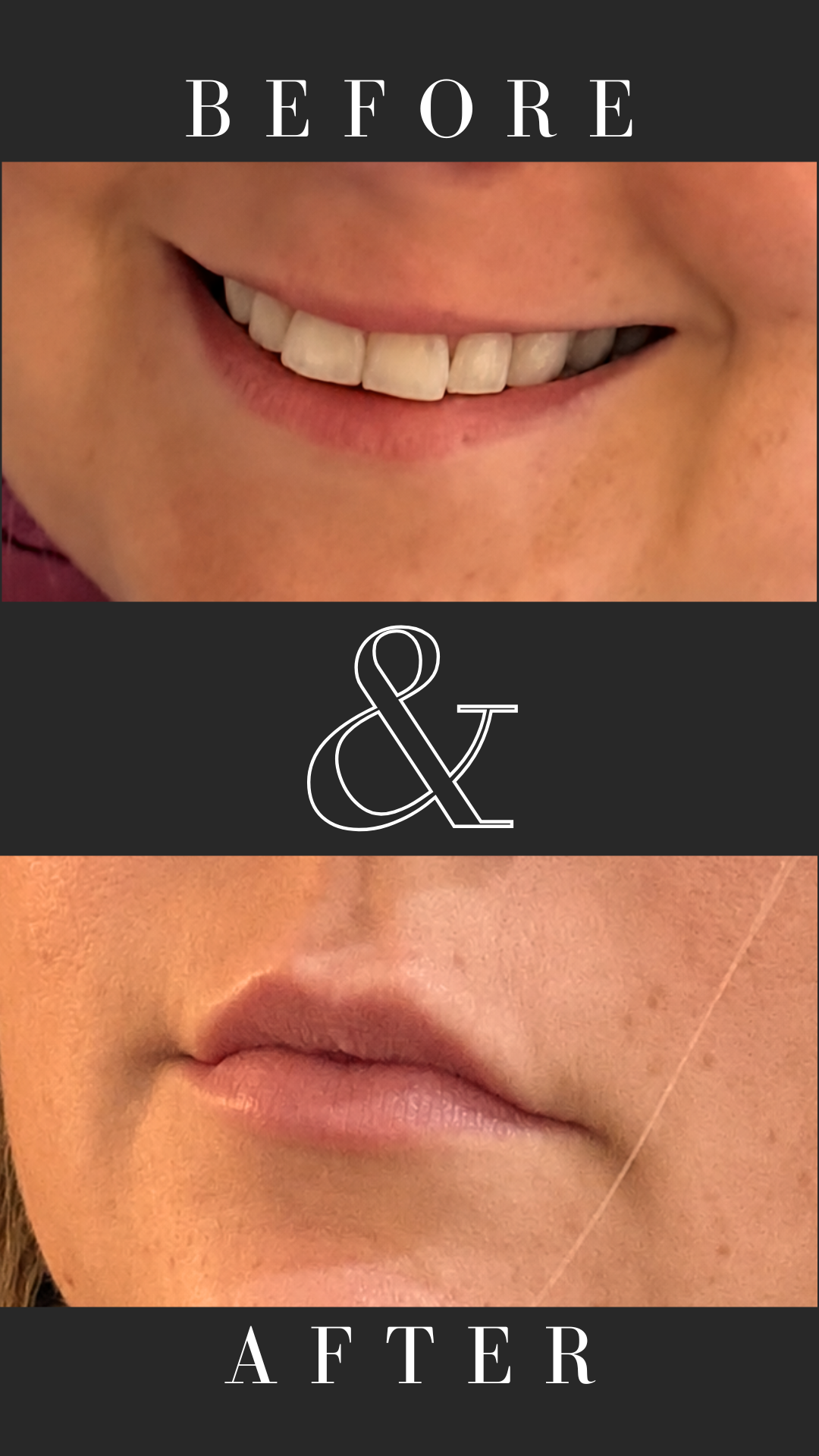 0.5ml lip filler (Teosyal RHA kiss)