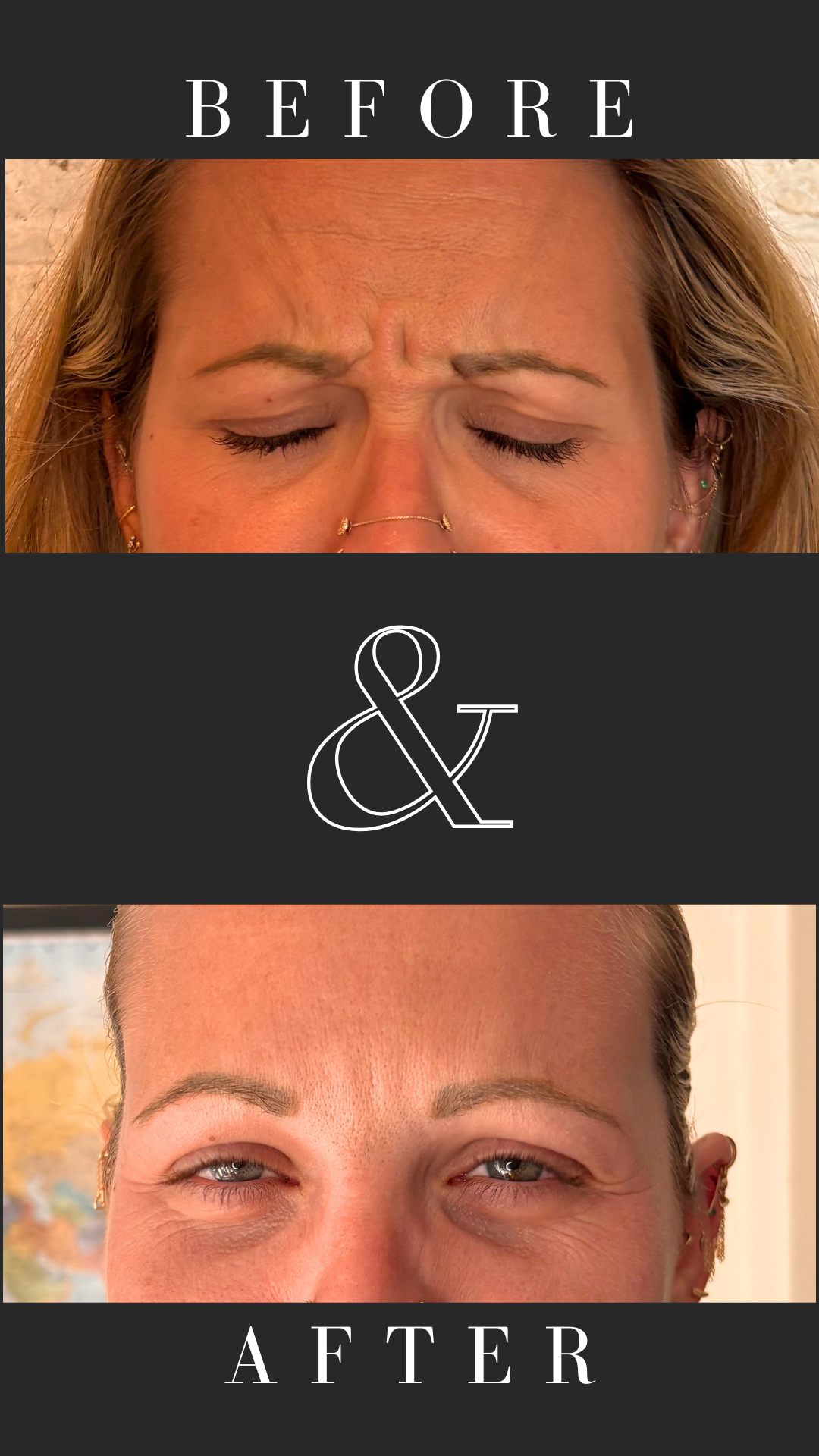 Anti-wrinkle treatment of frown lines