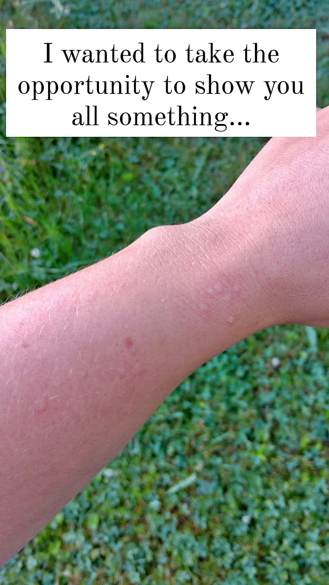 welps from nettles.jpg