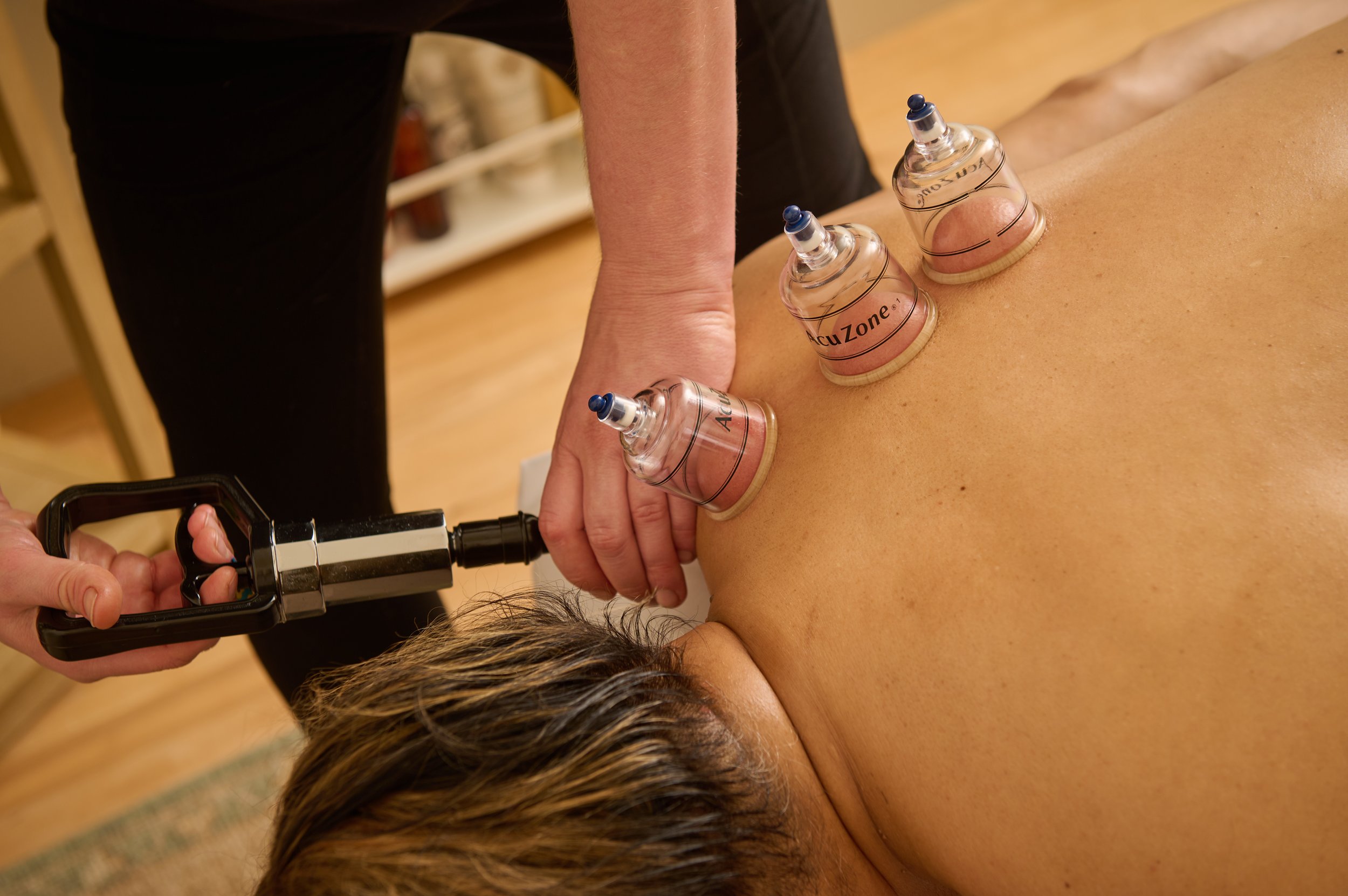 A person is receiving cupping therapy on their back with three glass cups, while a practitioner uses a vacuum device to create suction.
