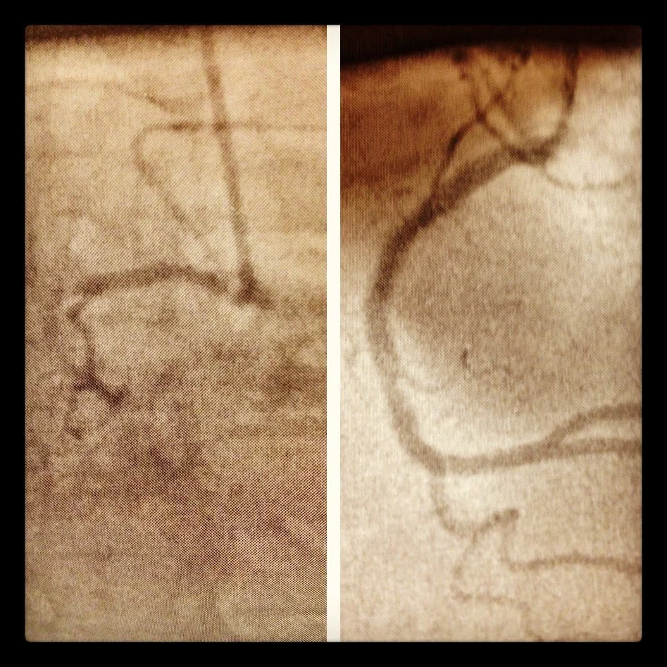 Heart Stent 