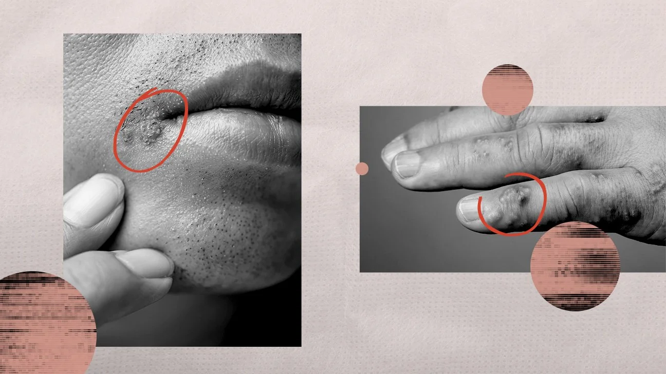 herpes-apperance-1296x728-header.jpg