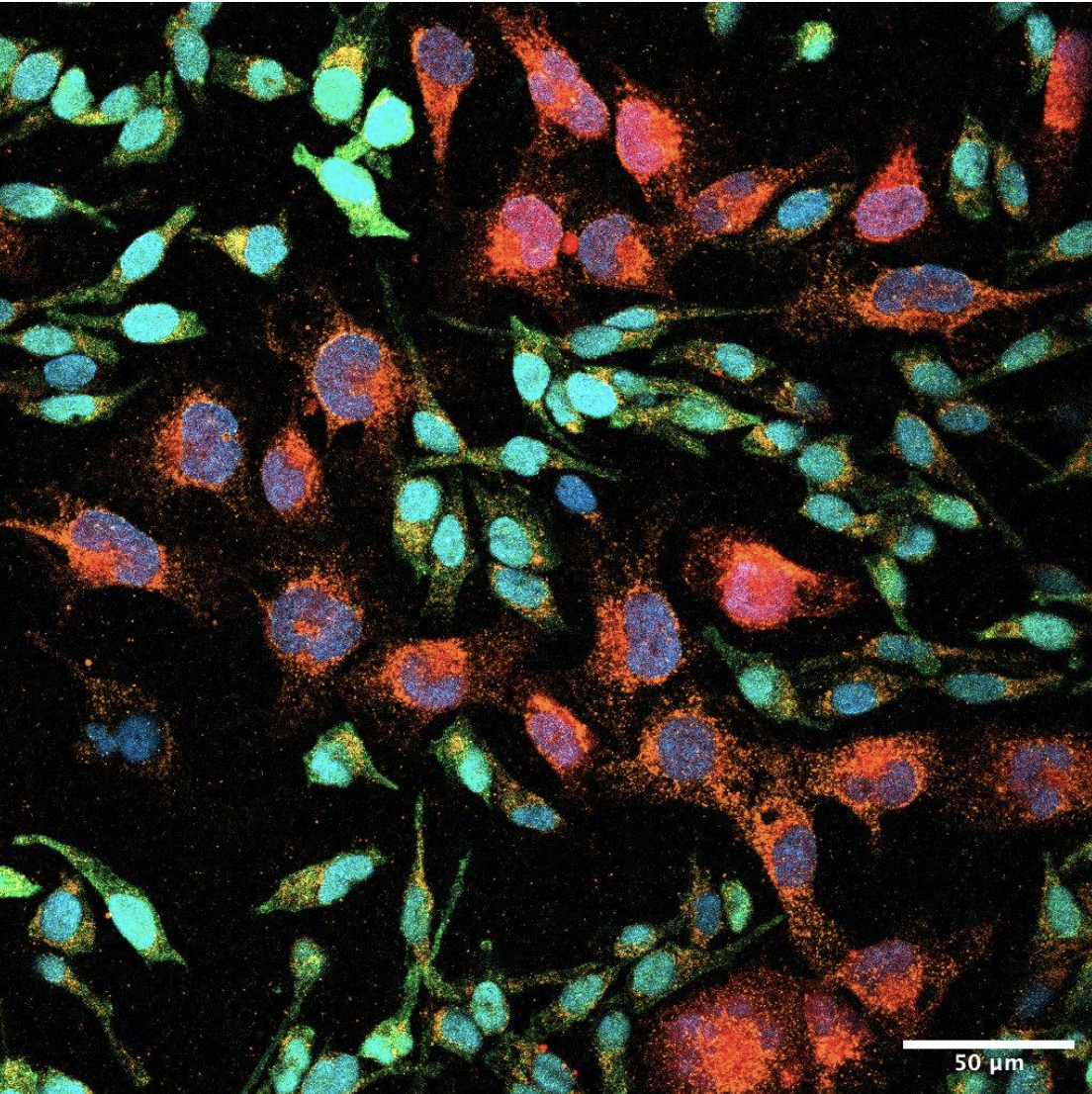Fluorescent microscopy image of co-culture of human microglia cell line HMC3 and patient derived human astrocytoma grade 4 cell line NCH1681 transduced with a shCD44 vector to knock down CD44 expression.