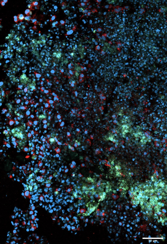 Fluorescent microscopy image of co-culture of cerebral organoids, iMGs and astrocytoma cells.