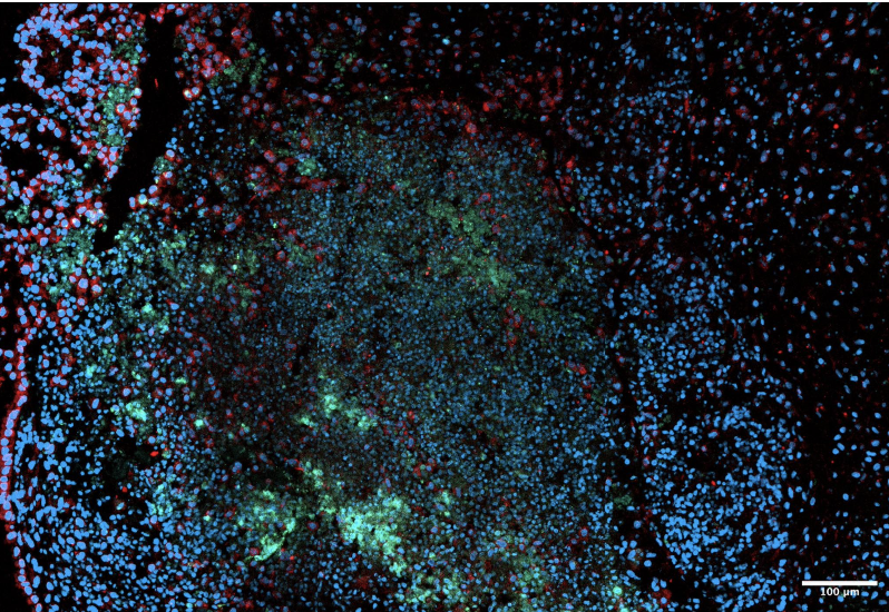 Fluorescent microscopy image of co-culture of cerebral organoids, iMGs and astrocytoma cells.