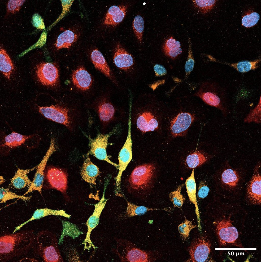 Colorful microscopic image of co-culture of human microglia cell line HMC3 and patient derived human astrocytoma grade 4 cell line NCH1681 transduced with a scramble control vector.
