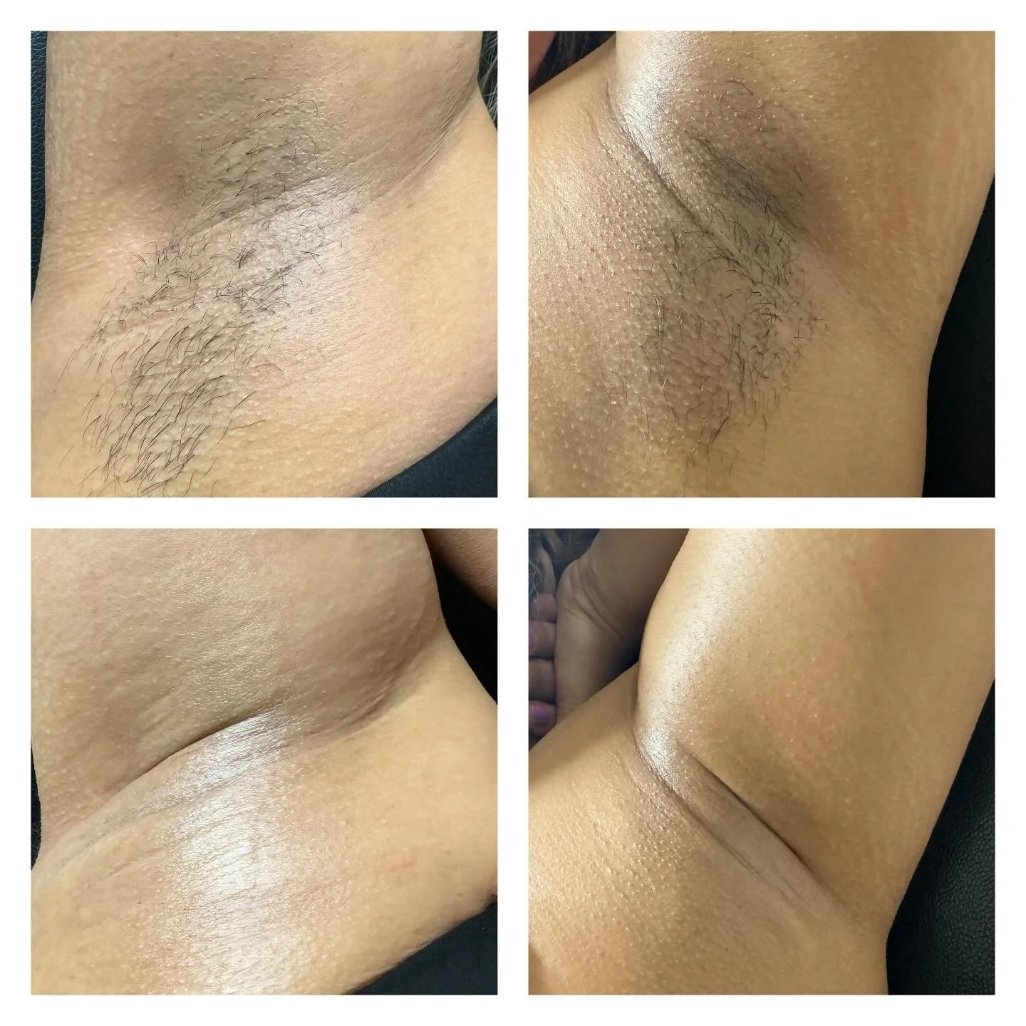 Before and after underarm waxing showing smooth, hair-free skin