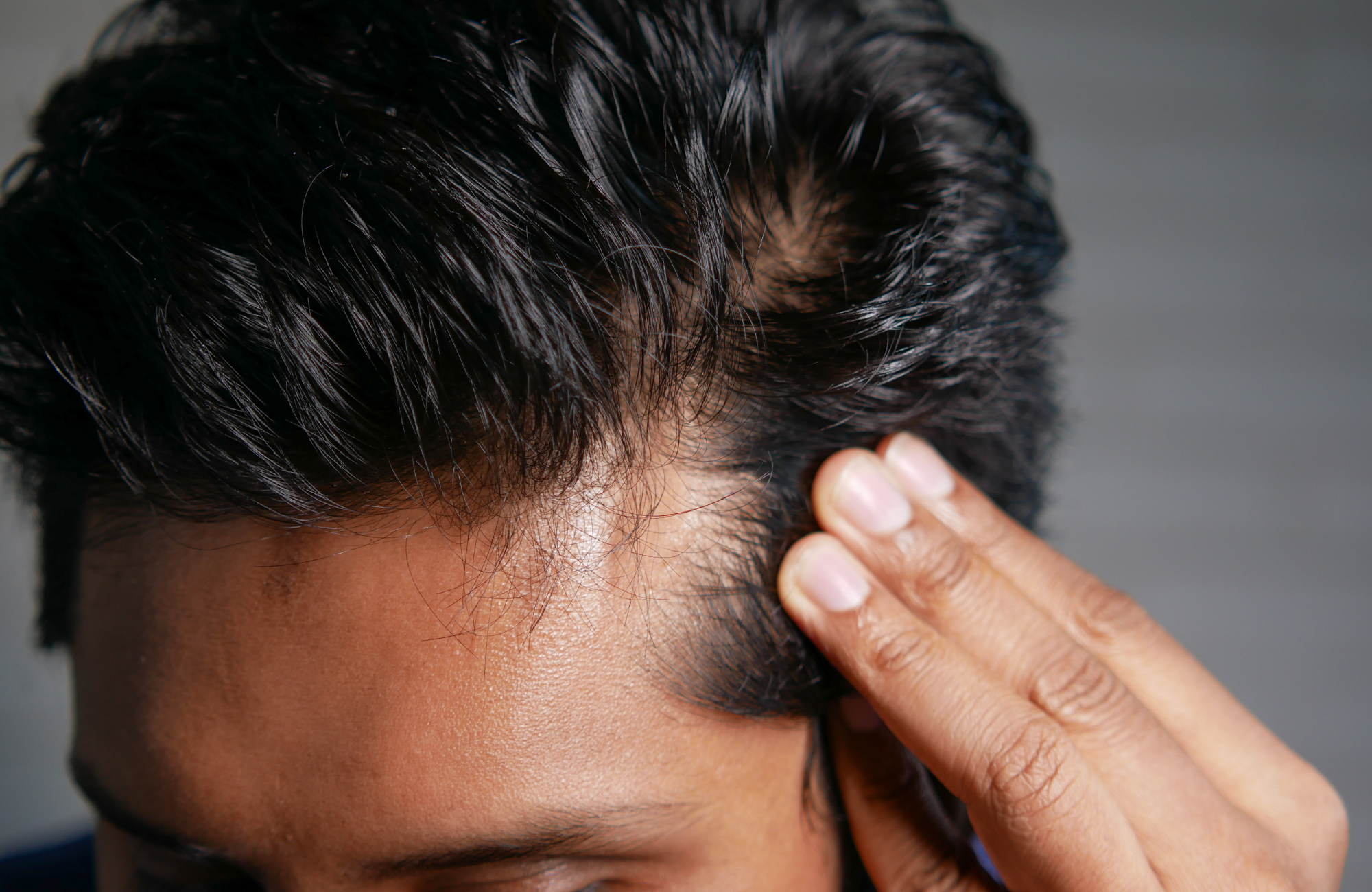 Hair restoration