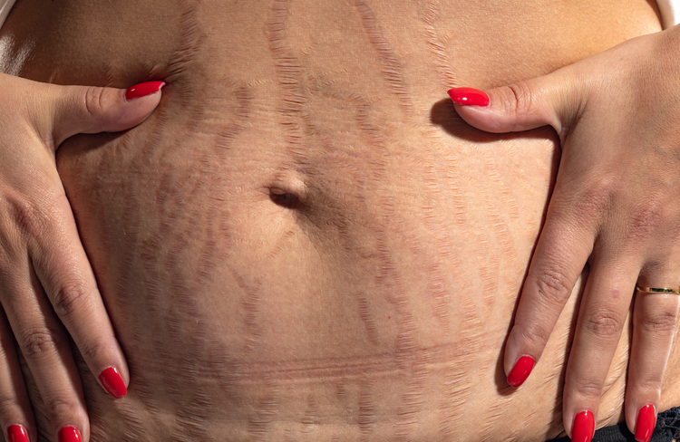 Skin concern that may be treated with medical microneedling