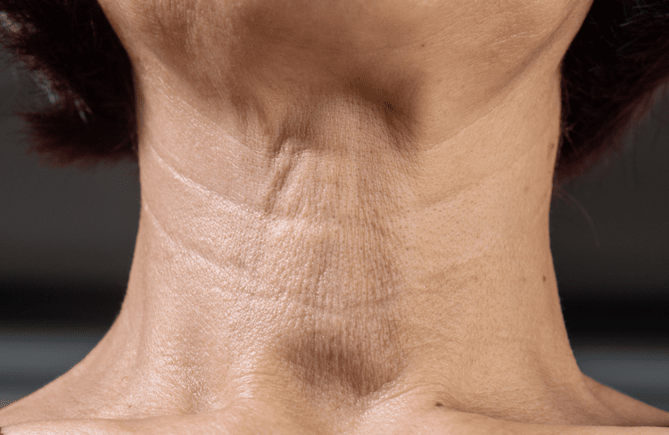 Skin concern that may be treated with medical microneedling