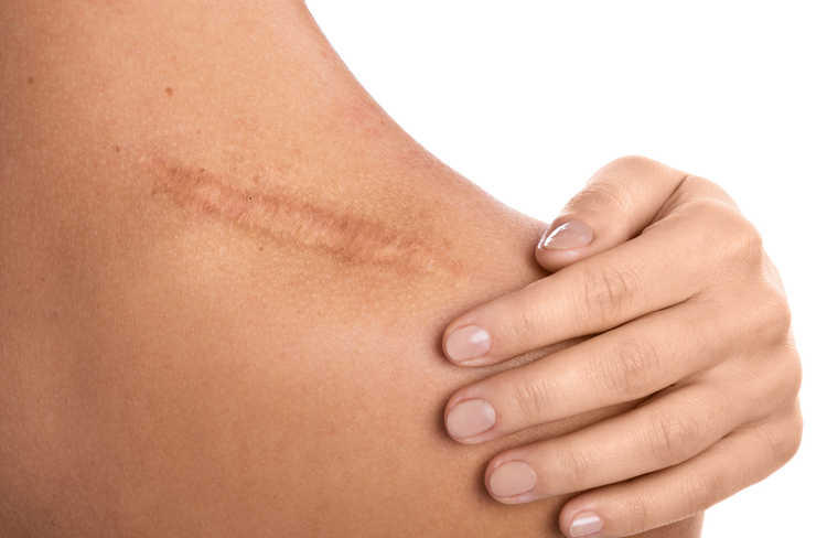 Skin concern that may be treated with medical microneedling