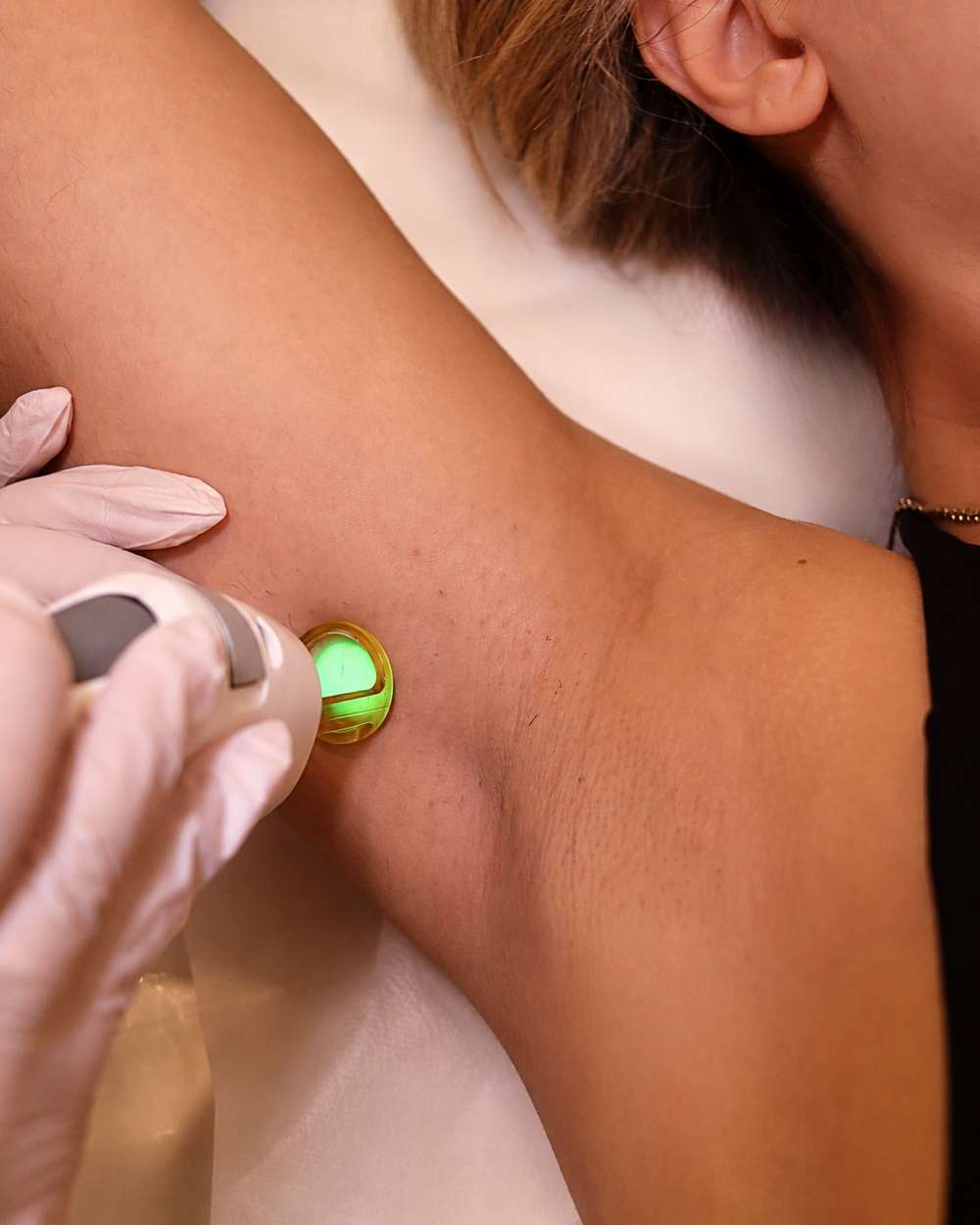 Laser Hair Removal