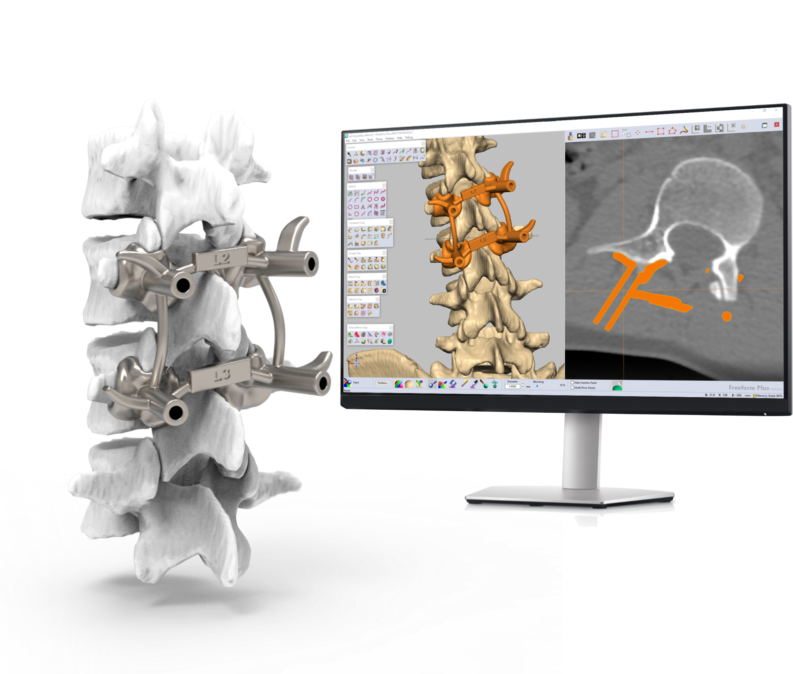 A medical implant being designed in Geomagic Freeform