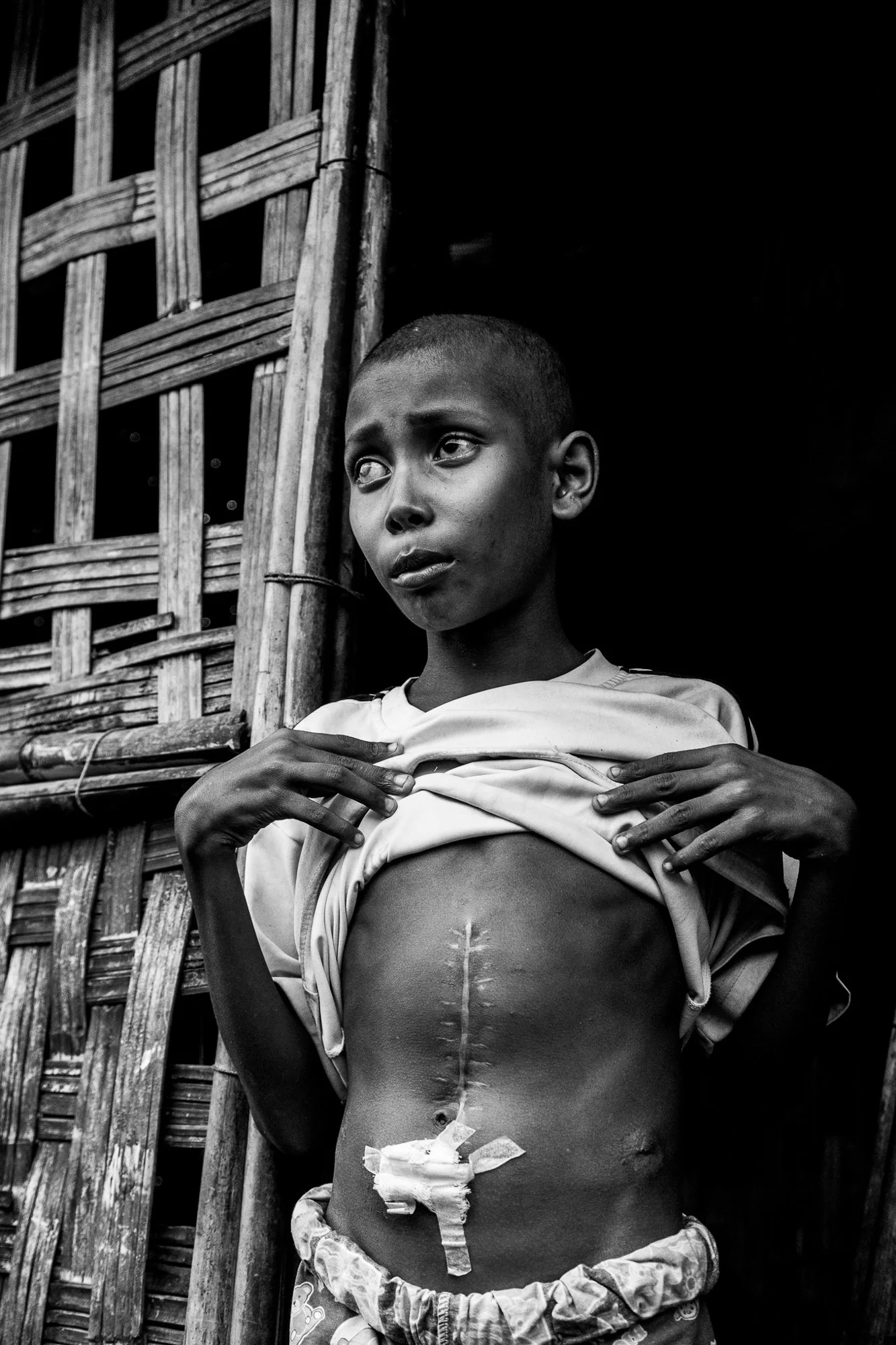 Rohingya boy Mohammed Rafiq shows surgical scars after receiving medical treatment outside a camp near Sittwe, Myanmar.