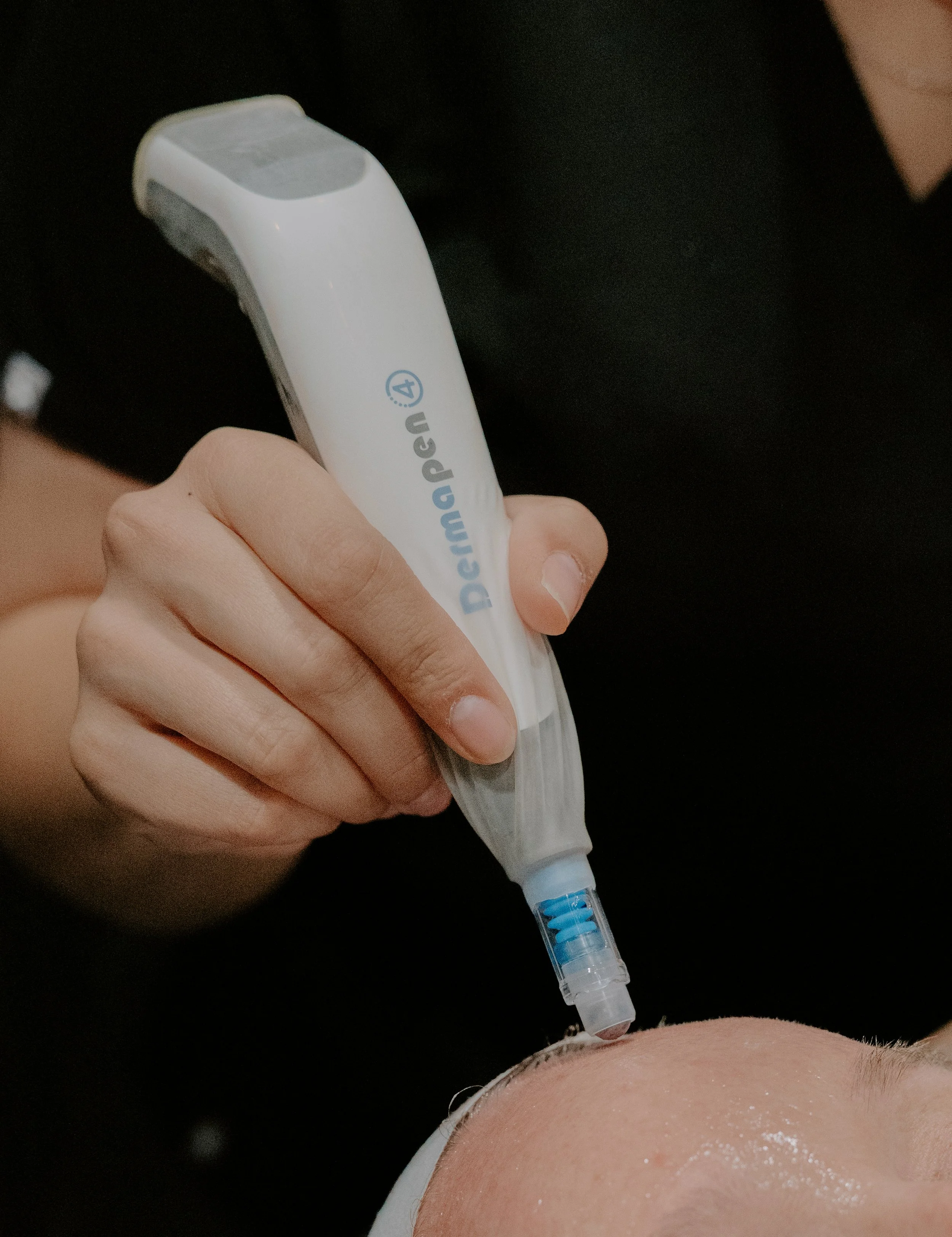 Close-up of a microneedling treatment on a patient's forehead.