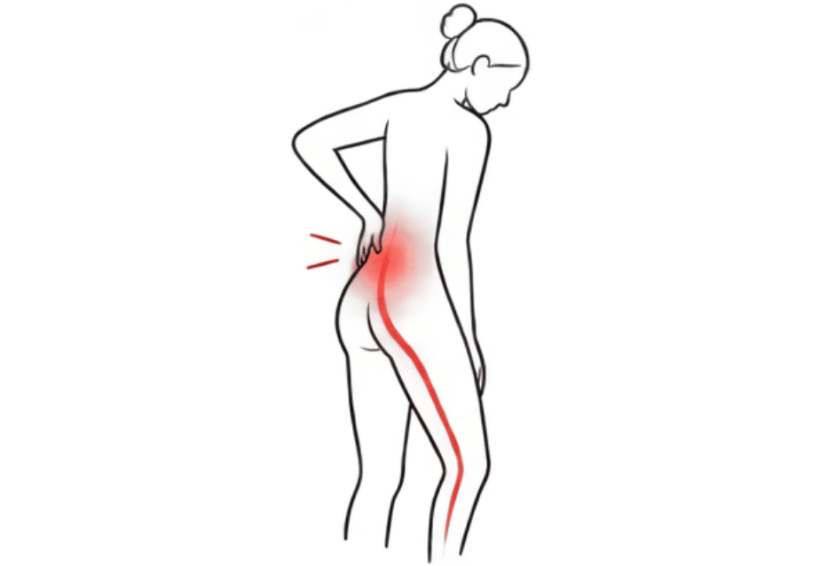 Anatomical silhouette highlighting the sciatic nerve path down the lower back and leg, representing sciatica massage therapy in Seattle's Eastside.