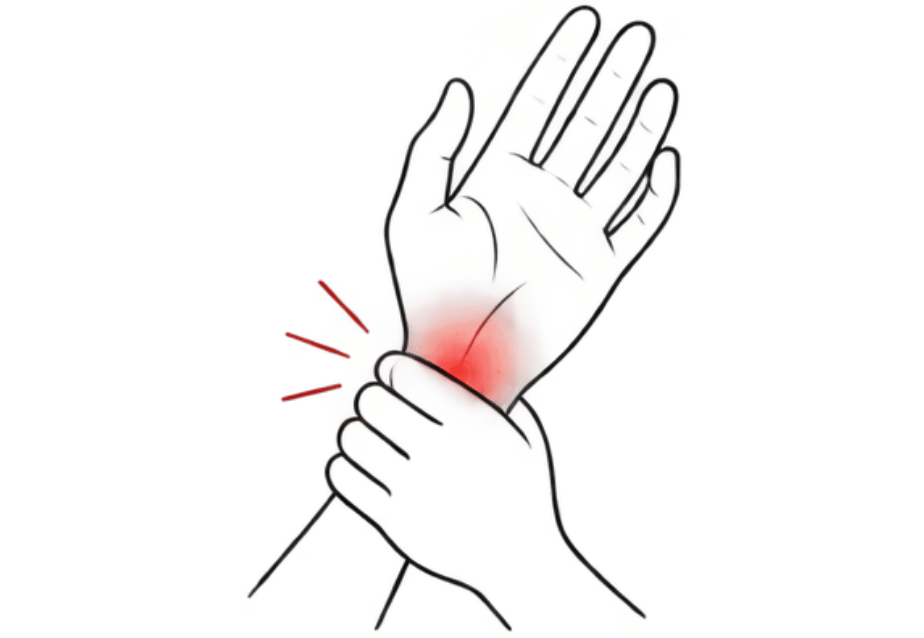 Clean line art highlighting nerve pain in the wrist and hand, representing carpal tunnel relief for tech professionals in Redmond.