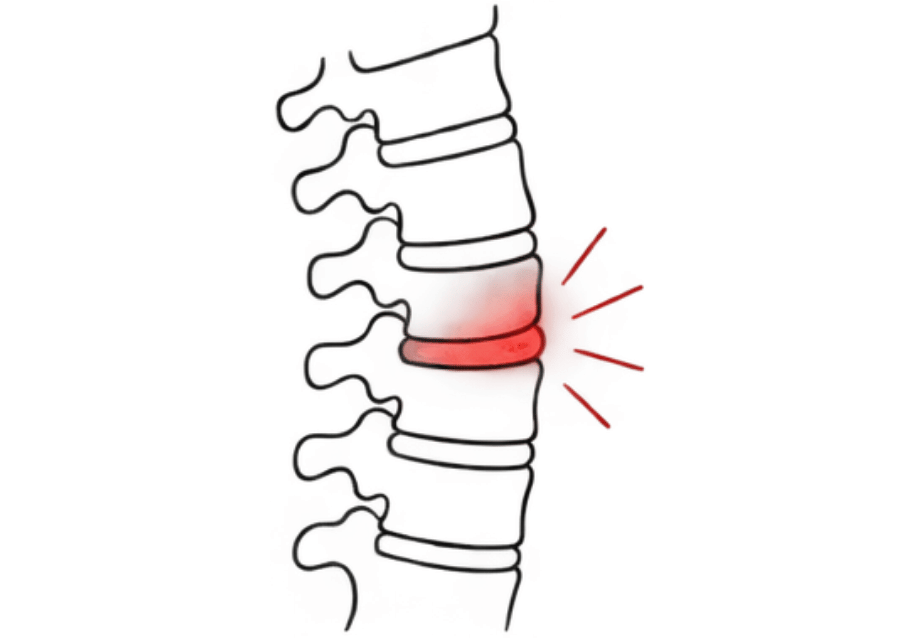 Medical line art of spinal vertebrae showing a compressed disc, illustrating targeted massage for spinal mobility in Bellevue.