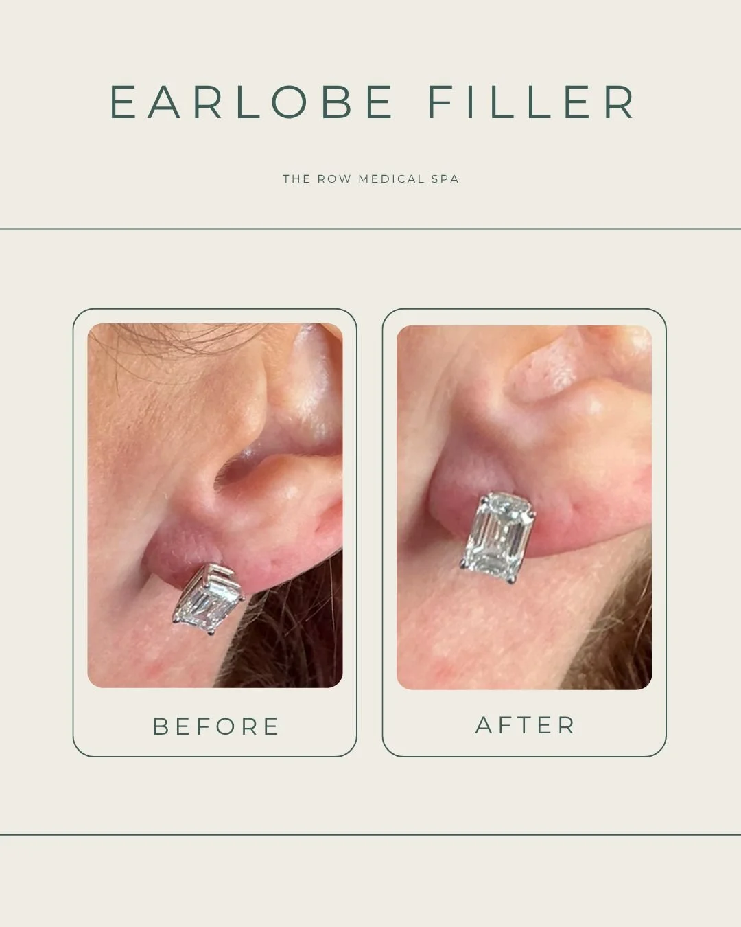 Your earlobes deserve a little love too. ✨

Over time, aging, genetics, and years of wearing earrings can cause earlobes to stretch and lose volume. Earlobe filler is a quick treatment that restores lost volume, helping earrings sit higher, fit more 