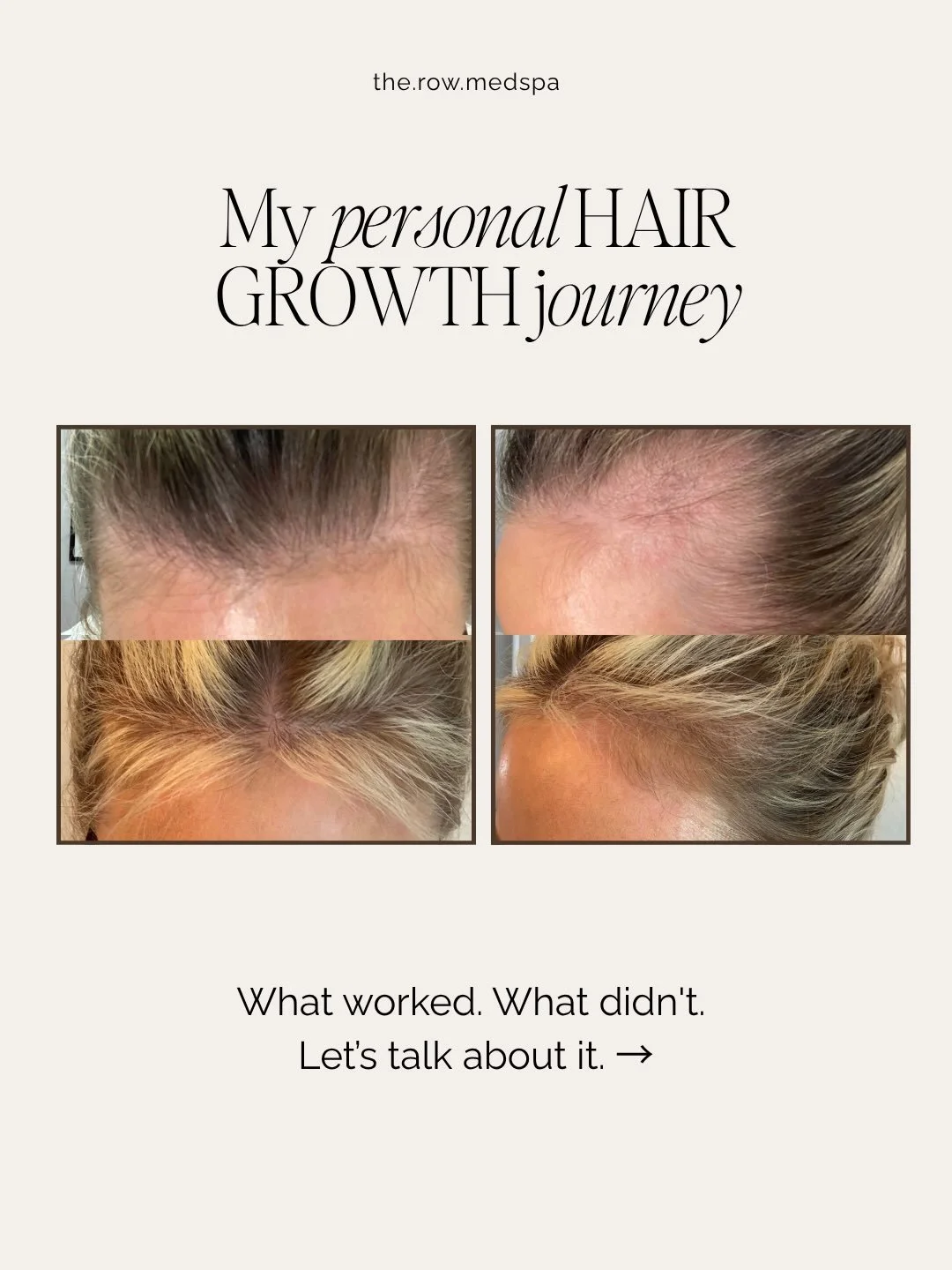 ✨ MY HAIR LOSS JOURNEY + WHAT FINALLY WORKED FOR ME ✨⁣
⁣
Hairloss took a much bigger emotional toll on me than I ever expected. Between hormone imbalances and thyroid disease, my hair became noticeably thinner, especially in the front, and my confide