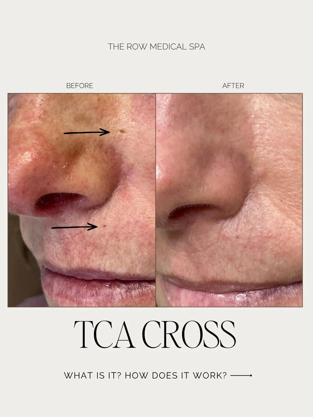TCA CROSS ✨ Tiny treatment. Targeted results.

TCA CROSS (Trichloroacetic Acid Chemical Reconstruction of Skin Scars) is a precision treatment that uses a high-strength TCA solution placed directly into individual scars or enlarged pores to create a 
