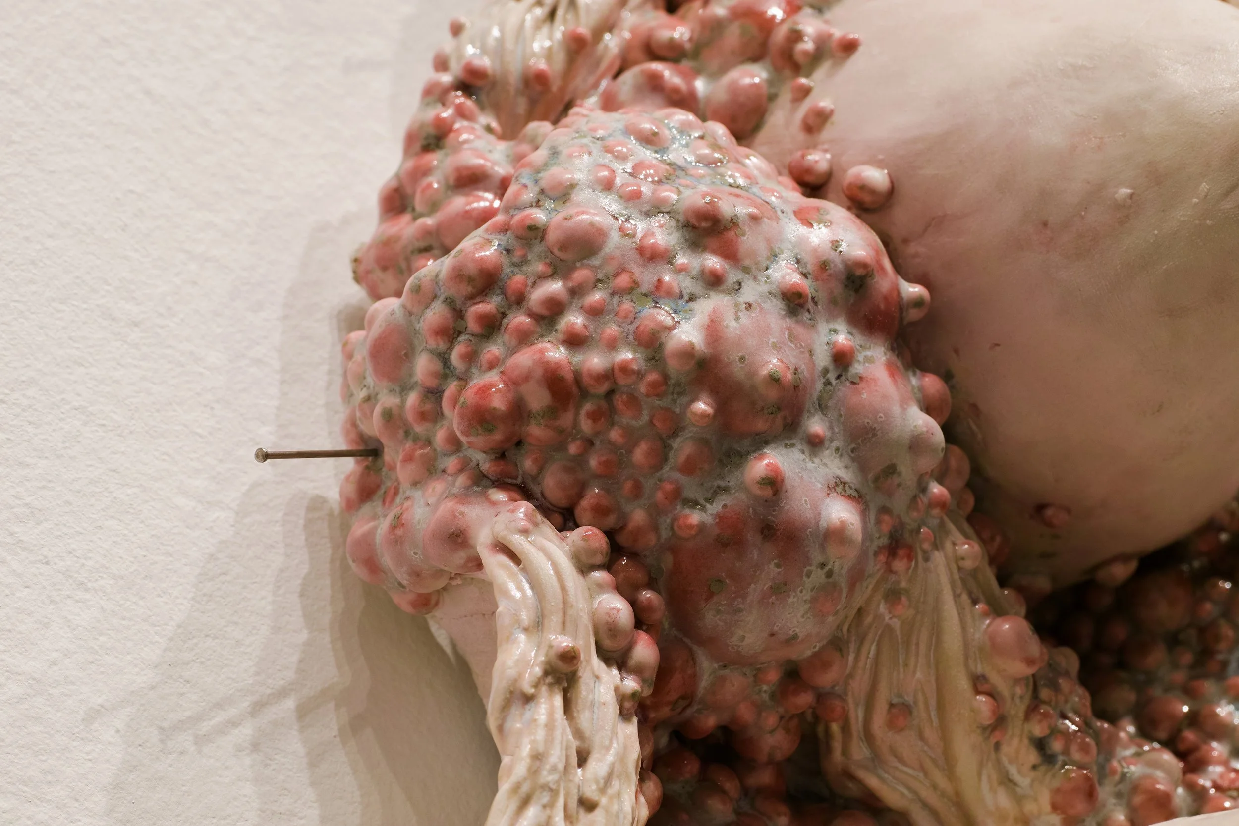 Close-up of a person's back with numerous skin bumps covered in a white, foamy substance.