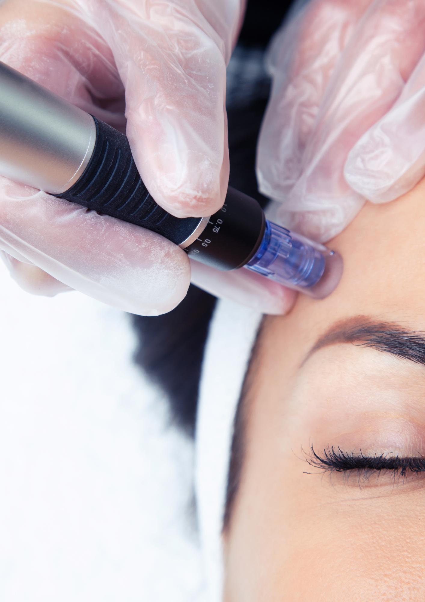 Microneedling treatment at Modus Skin Lab in Bourne