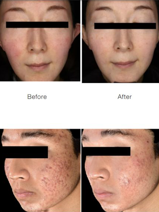 Side-by-side comparison of two individuals' faces showing clear improvements in skin condition, with the top set displaying before and after images of a woman with facial redness and the bottom set showing a man with facial acne and scars.