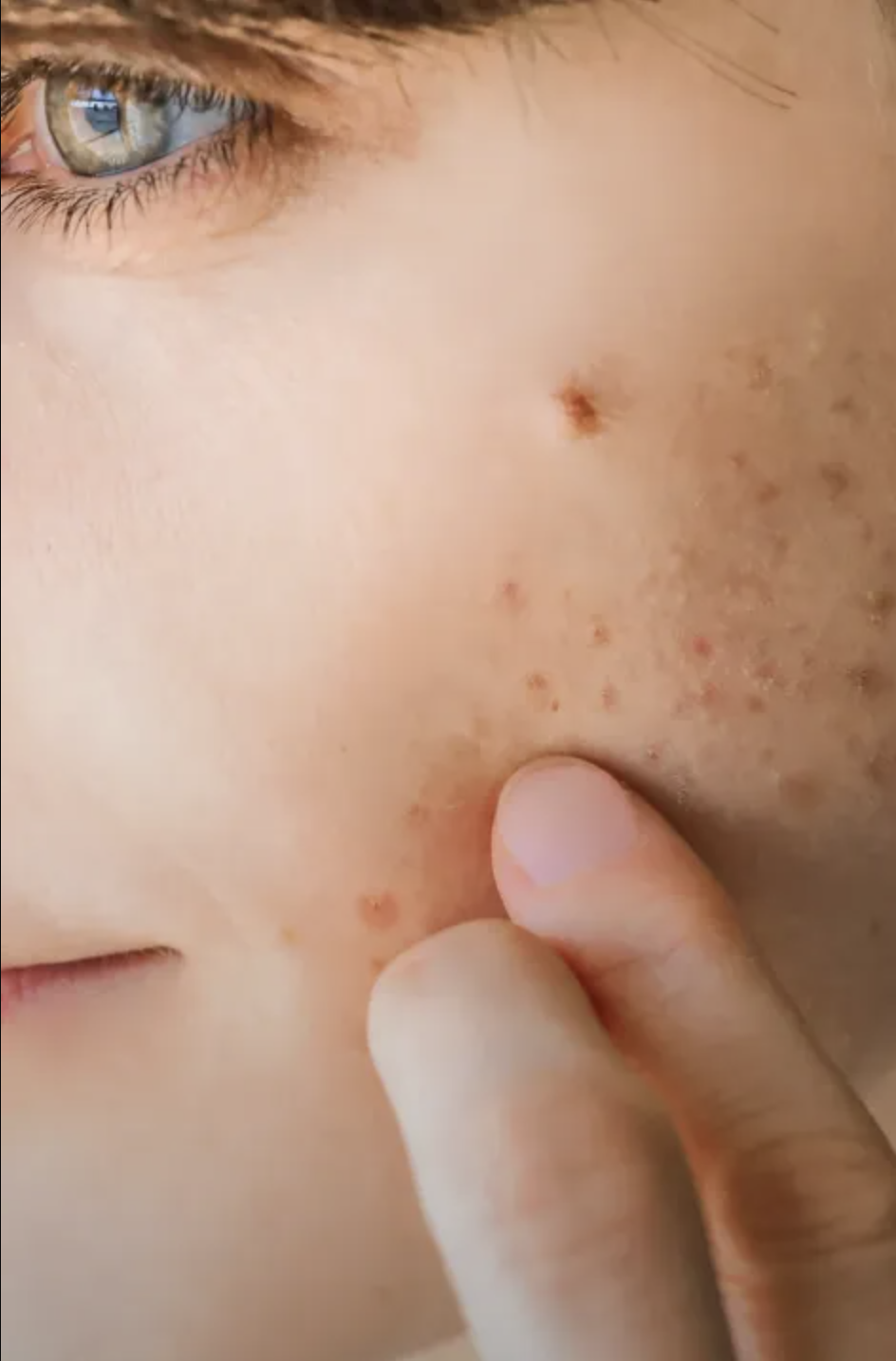 Close-up of a person's cheek with bumps and pimples, with someone pinching the skin near the nose.