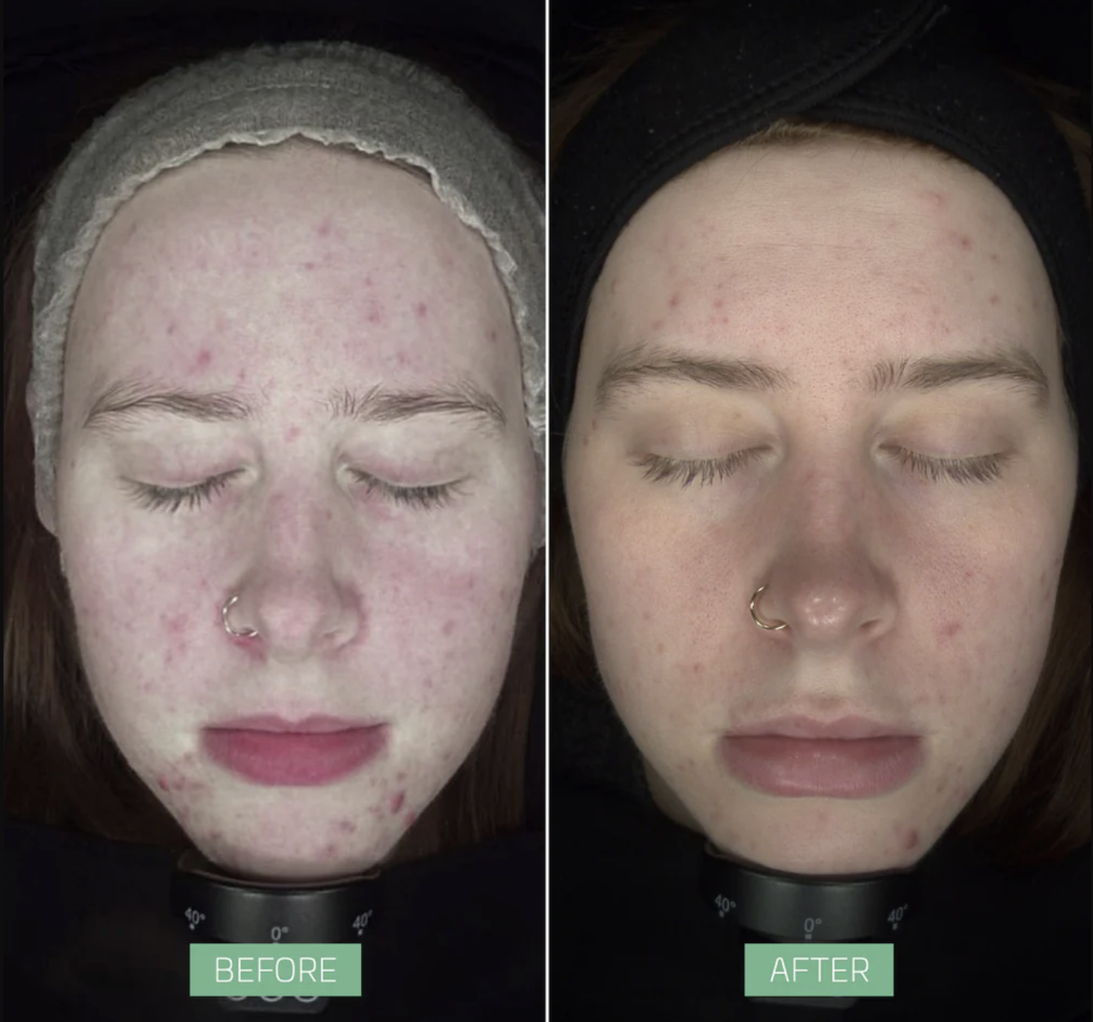 Side-by-side comparison of a woman’s face before and after skincare treatment, showing improvements in skin clarity and texture.