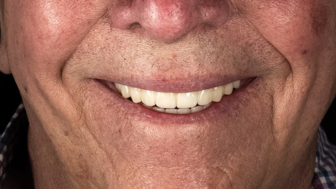 Close-up of a smiling person's mouth showing their teeth.