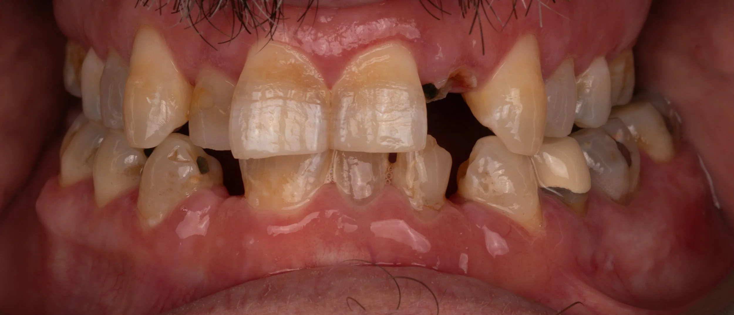 Close-up of person's mouth with crowded, discolored, and decayed teeth showing significant dental issues.