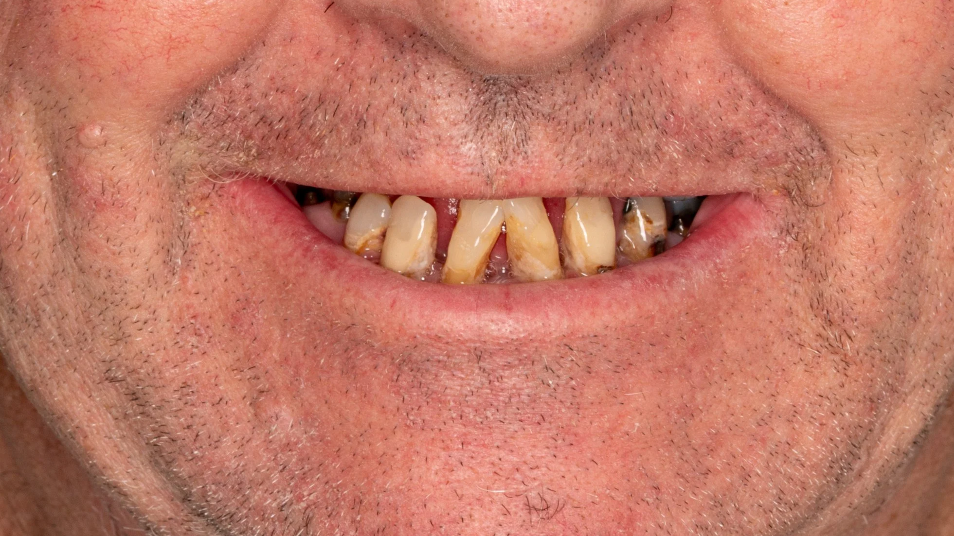 Close-up of a person smiling, showing stained, decayed, and crooked teeth with visible plaque buildup.