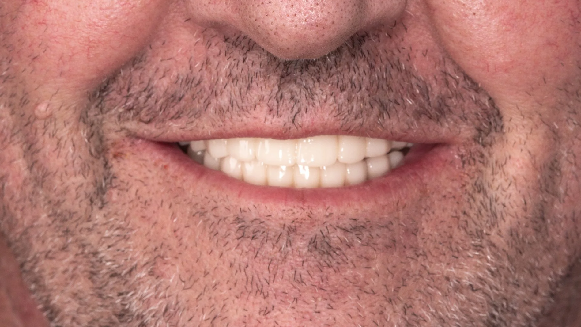 Close-up of a person's mouth smiling, showing upper and lower teeth, with facial hair and skin detail.