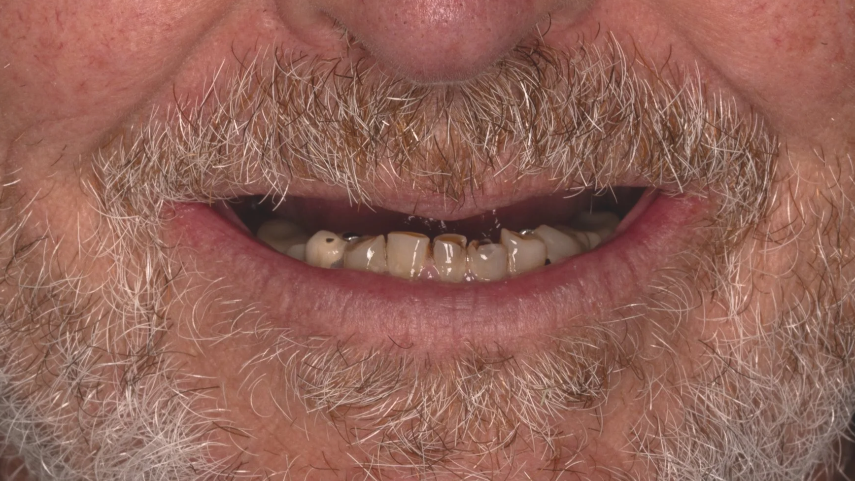 Close-up of a person's lower face showing teeth with significant decay, discoloration, and dental damage, along with a beard and mustache.
