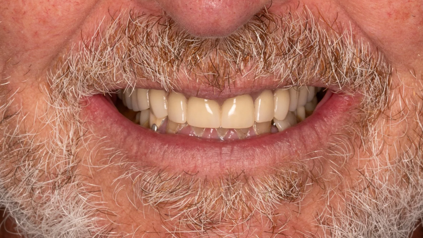 Close-up of a man's smiling mouth showing teeth, mustache, and beard with gray and white facial hair.