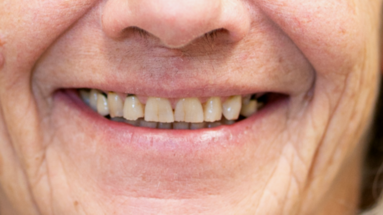 Close-up of an elderly person's smiling mouth showing uneven, discolored teeth.