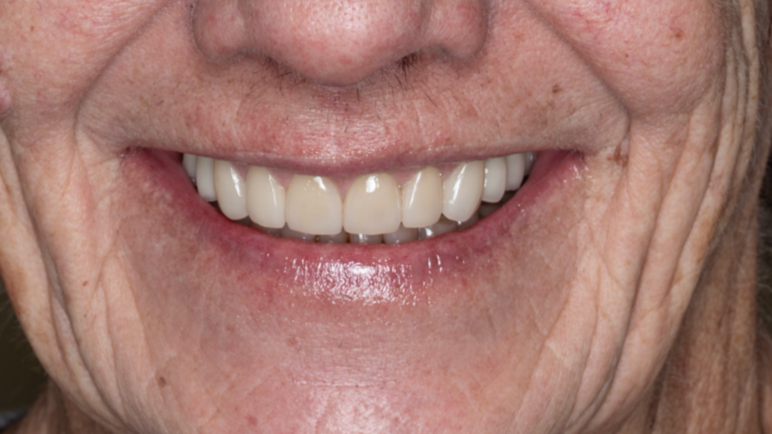 Close-up of a smiling elderly person's mouth showing their teeth and lips.