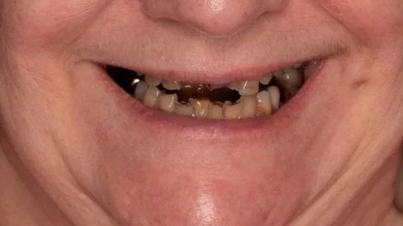 Close-up of a person's mouth showing decayed and missing teeth.