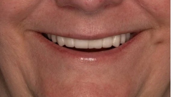 Close-up of a smiling person's mouth with visible teeth.